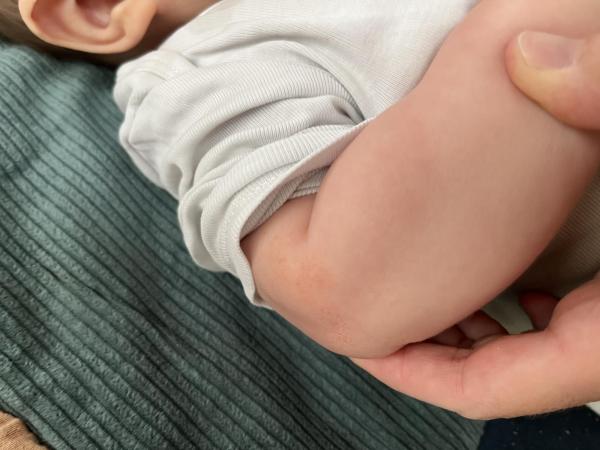 Bild zu Anfang Neurodermitis - Haut von Babys und Kindern ✔️ Expertenforum