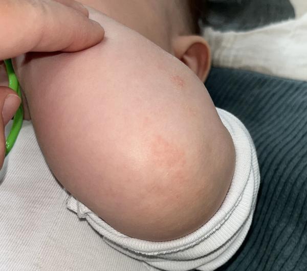 Bild zu Anfang Neurodermitis - Haut von Babys und Kindern ✔️ Expertenforum