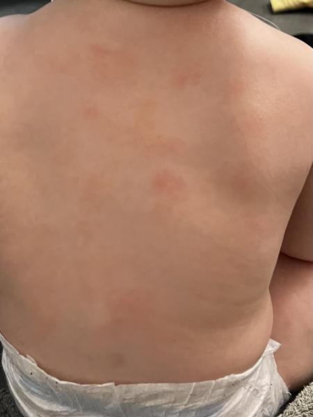 Bild zu Neurodermitis - Ja oder nein? - Haut von Babys und Kindern ✔️ Expertenforum