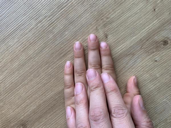 Bild zu Fingernagel - Haut von Babys und Kindern ✔️ Expertenforum