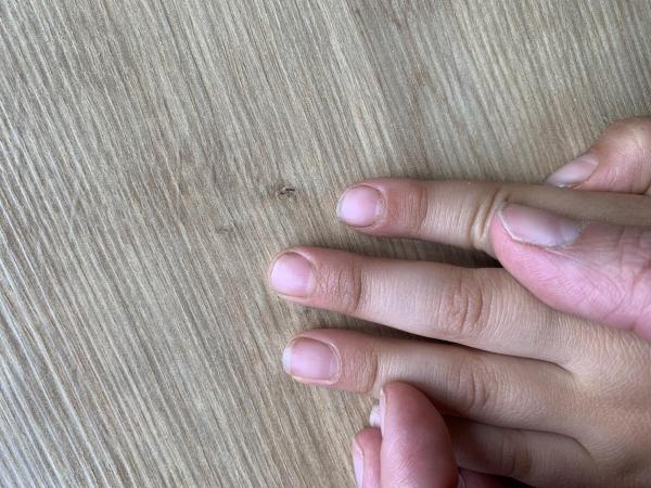 Bild zu Fingernagel - Haut von Babys und Kindern ✔️ Expertenforum