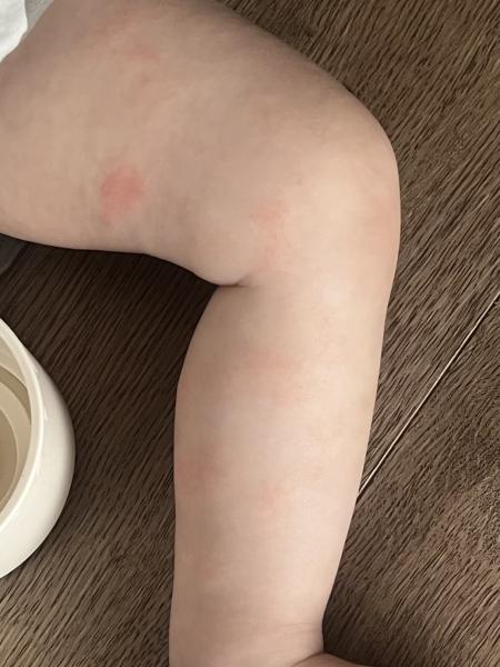 Bild zu Neurodermitis - Ja oder nein? - Haut von Babys und Kindern ✔️ Expertenforum