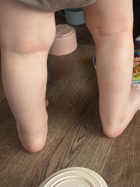 Bild zu Neurodermitis - Ja oder nein? - Haut von Babys und Kindern ✔️ Expertenforum