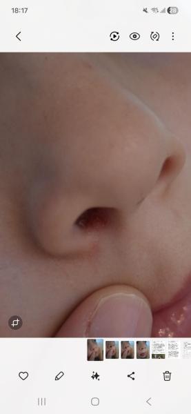 Bild zu Nase - Haut von Babys und Kindern ✔️ Expertenforum