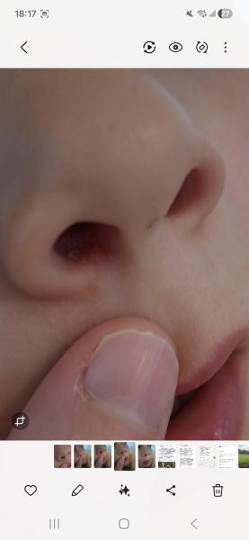 Bild zu Nase - Haut von Babys und Kindern ✔️ Expertenforum