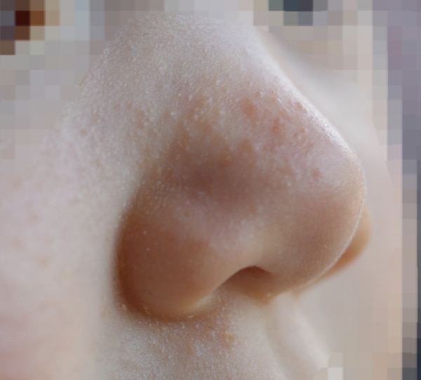 Bild zu Neurodermitis Ekzem und Akne? - Haut von Babys und Kindern ✔️ Expertenforum