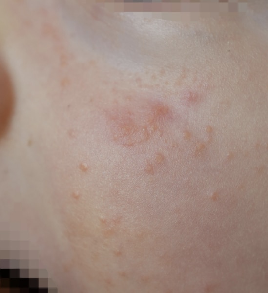 Bild zu Neurodermitis Ekzem und Akne? - Haut von Babys und Kindern ✔️ Expertenforum