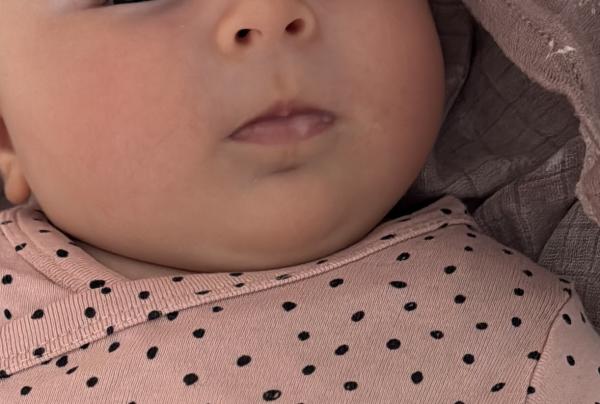 Bild zu Seltsame Stelle an der Lippe - Haut von Babys und Kindern ✔️ Expertenforum