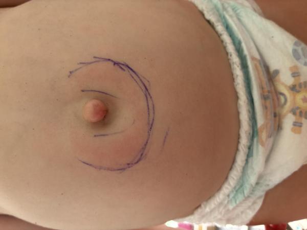 Bild zu Wanderröte oder Ekzem - Haut von Babys und Kindern ✔️ Expertenforum