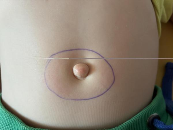 Bild zu Wanderröte oder Ekzem - Haut von Babys und Kindern ✔️ Expertenforum