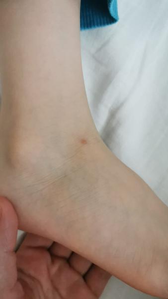 Bild zu Knötchen - Haut von Babys und Kindern ✔️ Expertenforum