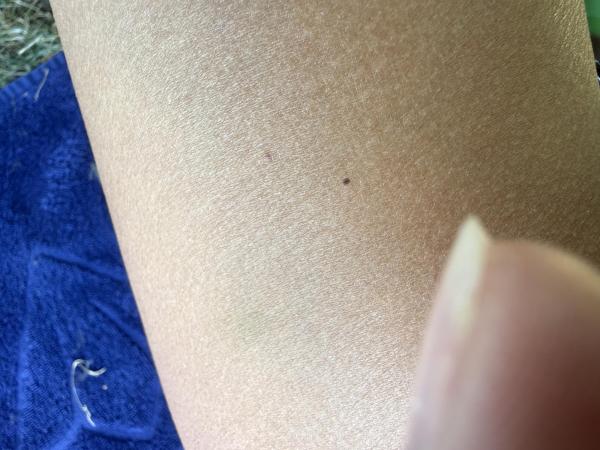 Bild zu neues Muttermal - Haut von Babys und Kindern ✔️ Expertenforum