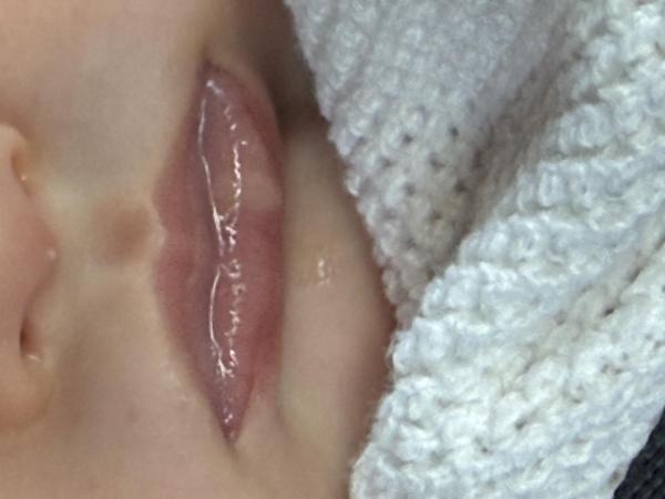 Bild zu Seltsame Stelle an der Lippe - Haut von Babys und Kindern ✔️ Expertenforum