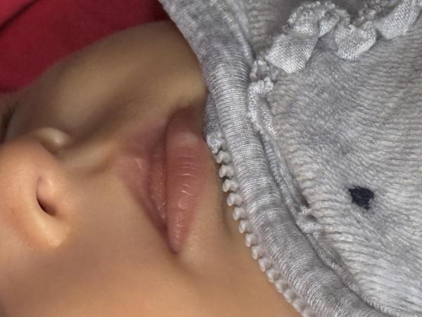 Bild zu Seltsame Stelle an der Lippe - Haut von Babys und Kindern ✔️ Expertenforum