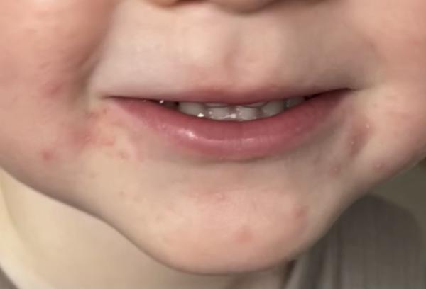 Bild zu Periorale Dermatitis? - Haut von Babys und Kindern ✔️ Expertenforum