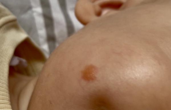 Bild zu Juveniles Xanthogranulom - Haut von Babys und Kindern ✔️ Expertenforum