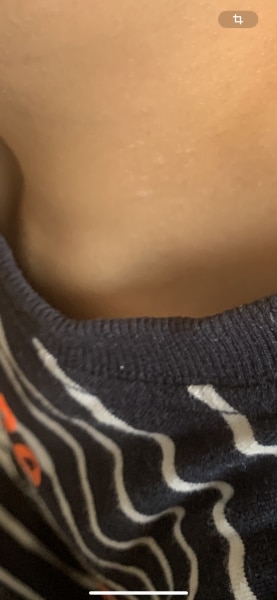 Bild zu Weißliche Flecken - Haut von Babys und Kindern ✔️ Expertenforum