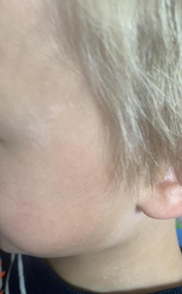 Bild zu Weißliche Flecken - Haut von Babys und Kindern ✔️ Expertenforum