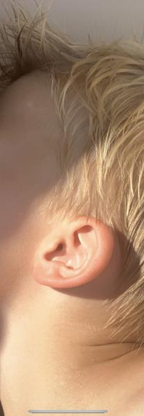Bild zu Weißliche Flecken - Haut von Babys und Kindern ✔️ Expertenforum