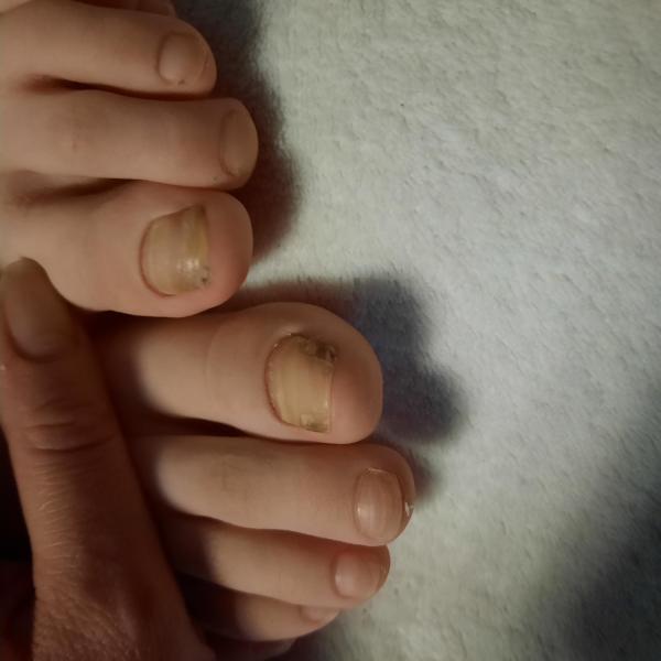 Bild zu Ciclopirox Nagellack für 10 Jährige ? - Haut von Babys und Kindern ✔️ Expertenforum
