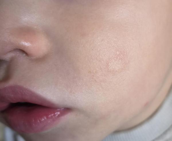 Bild zu auffälliges Stelle im Gesicht - Haut von Babys und Kindern ✔️ Expertenforum