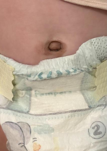 Bild zu Nabelgranulom Hautveränderung - Haut von Babys und Kindern ✔️ Expertenforum