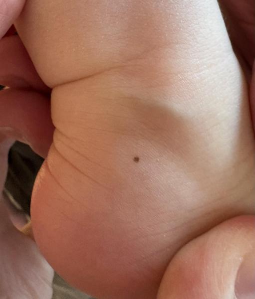 Bild zu Muttermal Kleinkind 17 Monate - Haut von Babys und Kindern ✔️ Expertenforum