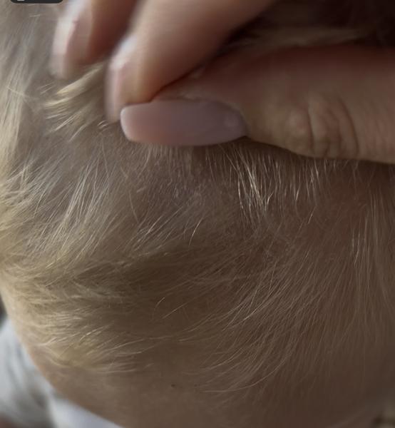 Bild zu Kopfhautjucken - Haut von Babys und Kindern ✔️ Expertenforum