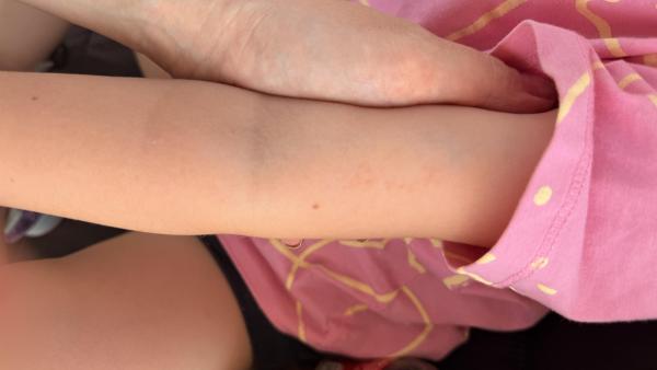 Bild zu Hautausschlag - Haut von Babys und Kindern ✔️ Expertenforum