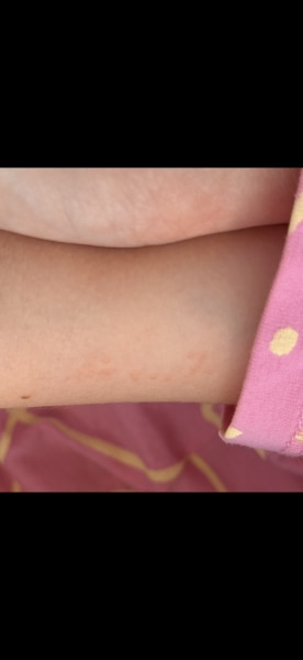 Bild zu Hautausschlag - Haut von Babys und Kindern ✔️ Expertenforum