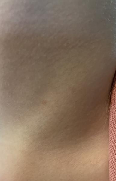 Bild zu Weitere Fotos zur Anfrage NF1 - Haut von Babys und Kindern ✔️ Expertenforum