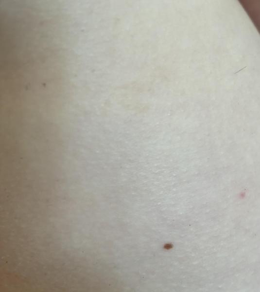 Bild zu Weitere Fotos zur Anfrage NF1 - Haut von Babys und Kindern ✔️ Expertenforum