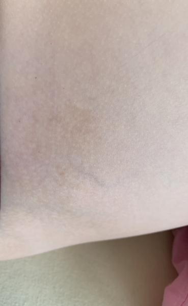 Bild zu NF1 - Haut von Babys und Kindern ✔️ Expertenforum