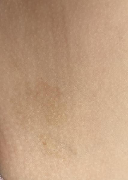 Bild zu Bessere Fotos zum Anliegen - Haut von Babys und Kindern ✔️ Expertenforum