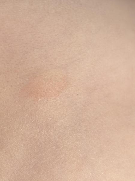 Bild zu Ausschlag - Haut von Babys und Kindern ✔️ Expertenforum