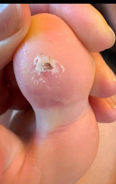 Bild zu Behandlungsempfehlung Dornwarze - Haut von Babys und Kindern ✔️ Expertenforum