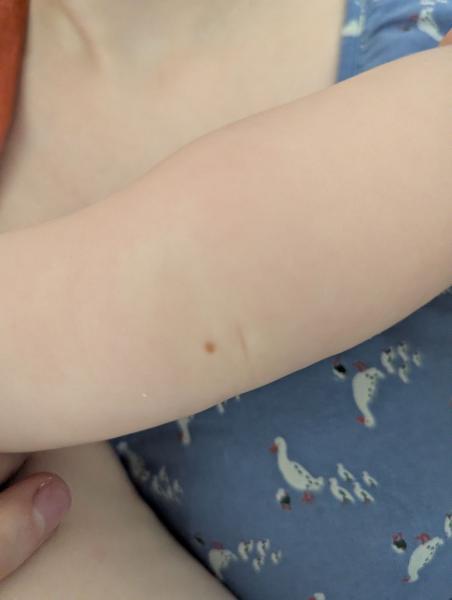 Bild zu Plötzlich Leberfleck bei 5 Monate altem Baby - Haut von Babys und Kindern ✔️ Expertenforum