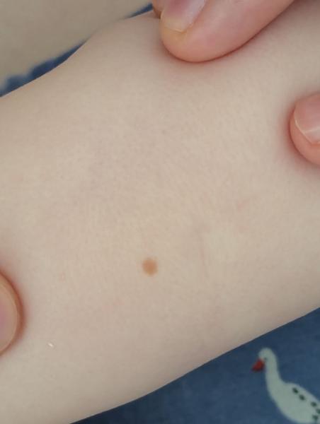 Bild zu Plötzlich Leberfleck bei 5 Monate altem Baby - Haut von Babys und Kindern ✔️ Expertenforum