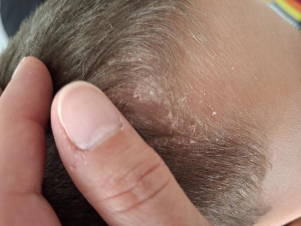 Bild zu Psoriasis? - Haut von Babys und Kindern ✔️ Expertenforum