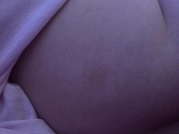 Bild zu Cafe au lait Flecken - Haut von Babys und Kindern ✔️ Expertenforum