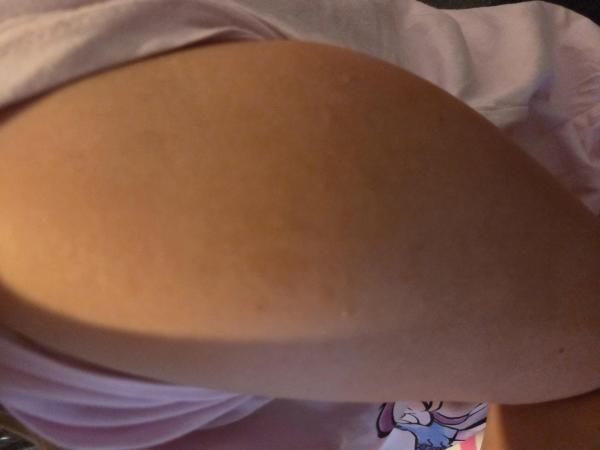 Bild zu Cafe au lait Flecken - Haut von Babys und Kindern ✔️ Expertenforum