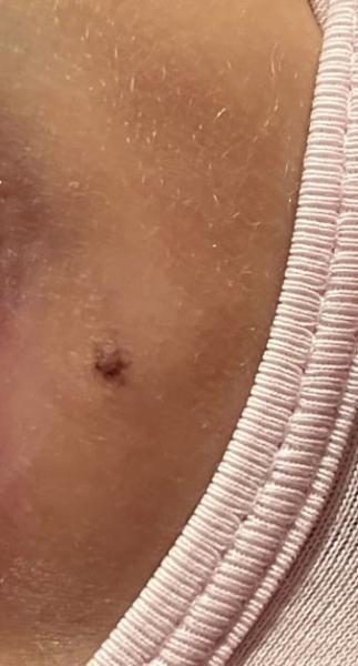 Bild zu Leberfleck Genitalbereich - Haut von Babys und Kindern ✔️ Expertenforum