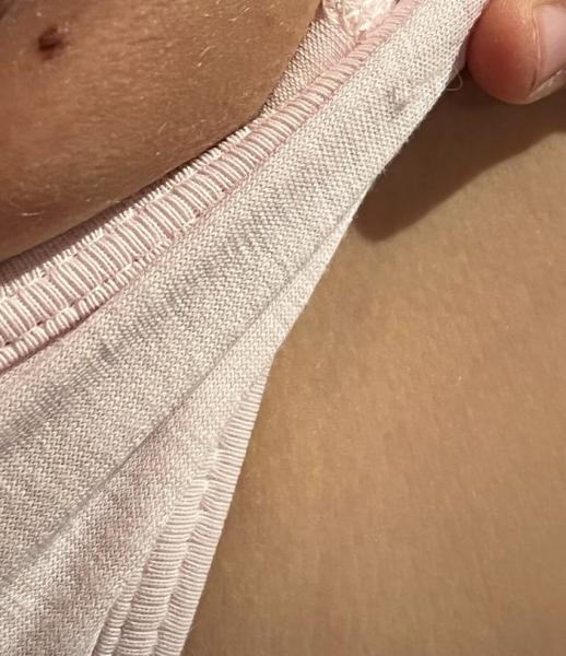 Bild zu Leberfleck Genitalbereich - Haut von Babys und Kindern ✔️ Expertenforum