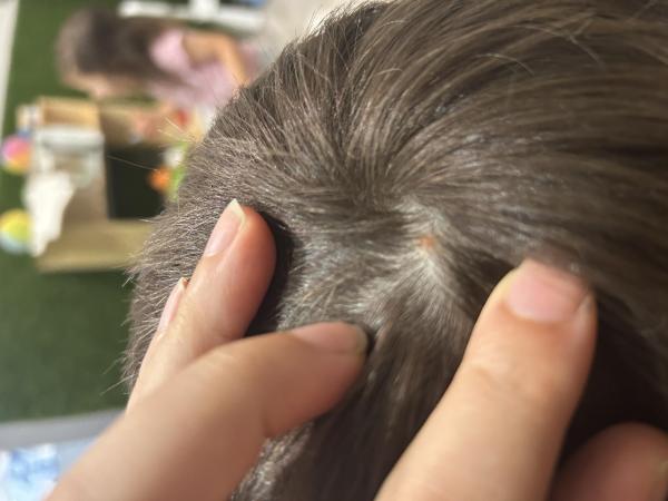 Bild zu Ausschlag wie Pickel - Haut von Babys und Kindern ✔️ Expertenforum