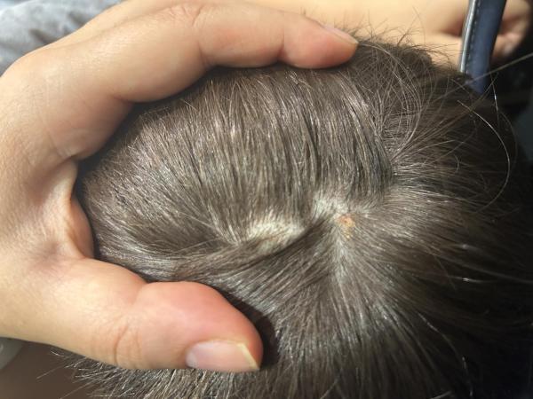 Bild zu Ausschlag wie Pickel - Haut von Babys und Kindern ✔️ Expertenforum