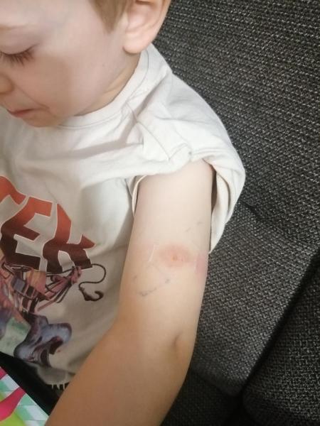 Bild zu Entzündeter Mückenstich - Haut von Babys und Kindern ✔️ Expertenforum
