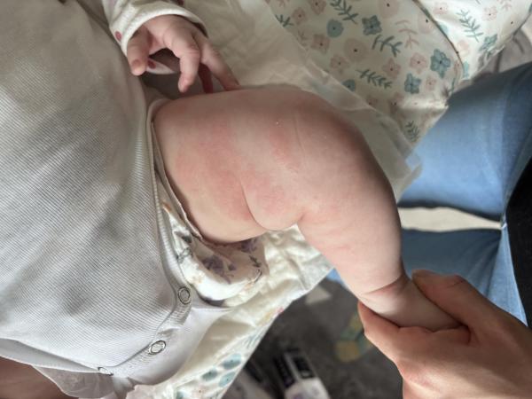 Bild zu Neurodermitis, Basispflege - Haut von Babys und Kindern ✔️ Expertenforum