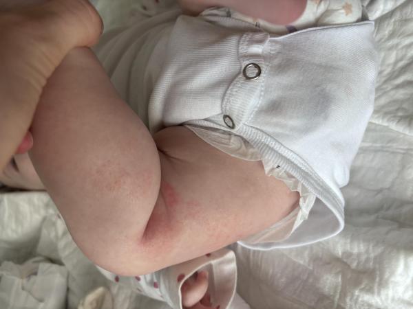 Bild zu Neurodermitis, Basispflege - Haut von Babys und Kindern ✔️ Expertenforum