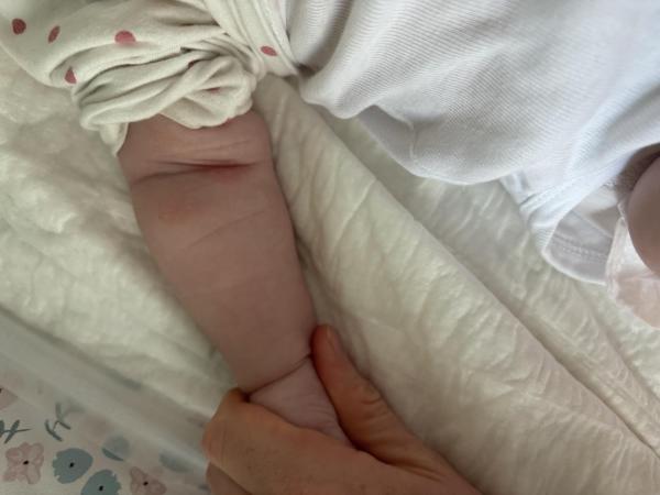 Bild zu Neurodermitis, Basispflege - Haut von Babys und Kindern ✔️ Expertenforum