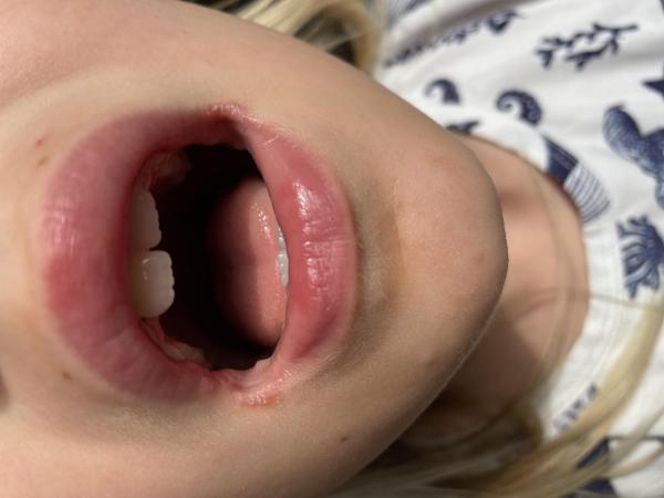 Bild zu entzündete Mundwinkel immer noch - Haut von Babys und Kindern ✔️ Expertenforum